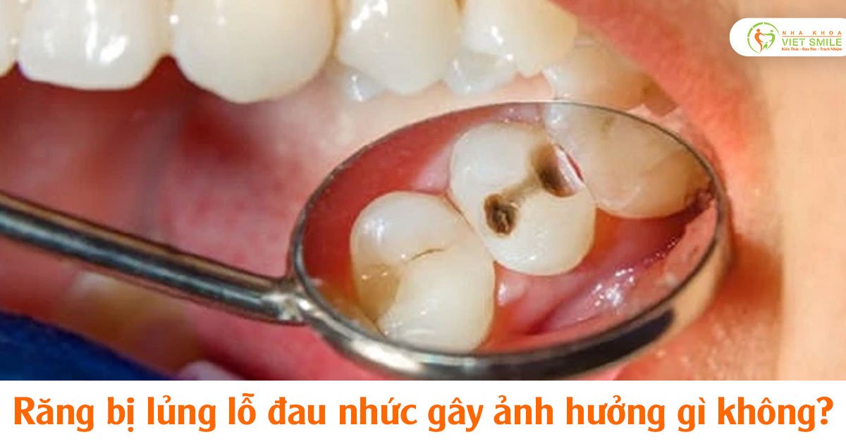 Răng bị lủng lỗ đau nhức gây ảnh hưởng gì không?