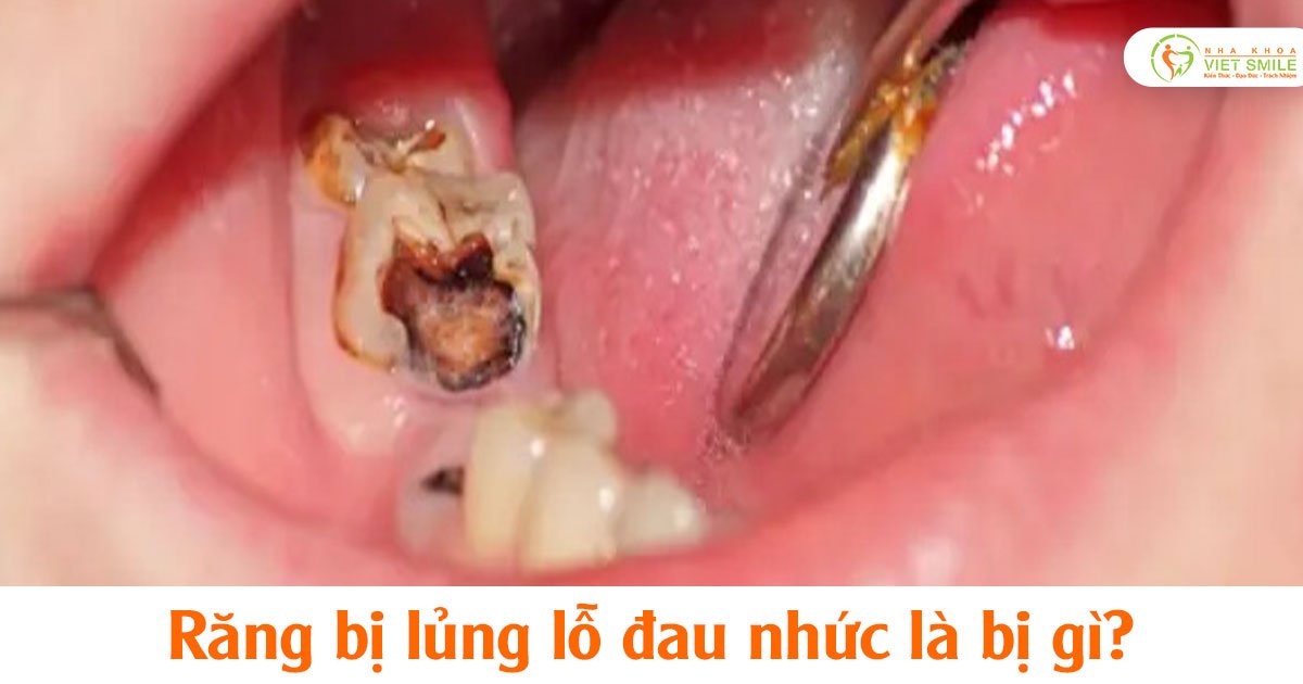 Răng bị lủng lỗ đau nhức là bị gì?