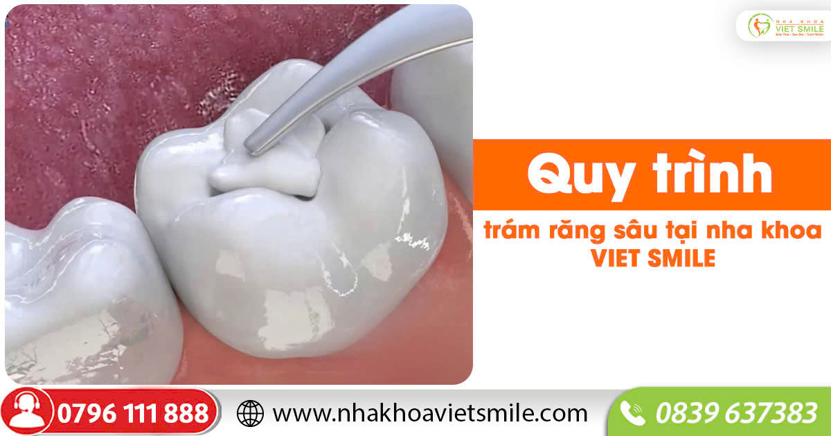 Quy trình trám răng sâu tại nha khoa viet smile