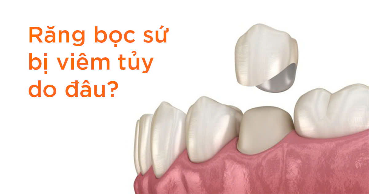 Răng bọc sứ bị viêm tủy do đâu?