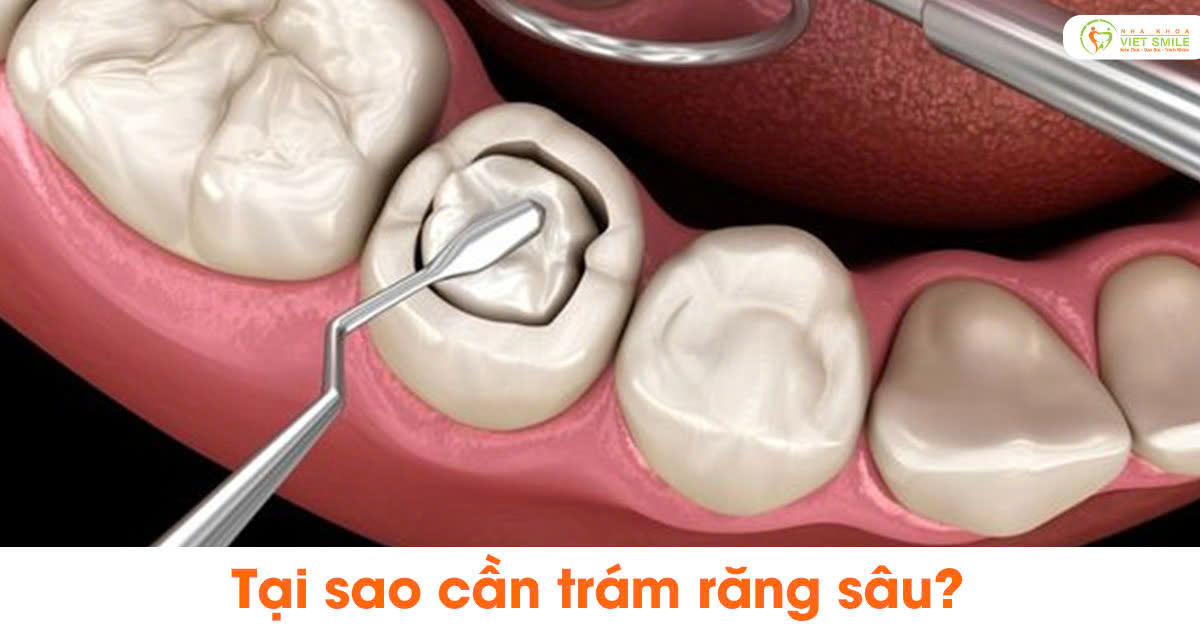 Tại sao cần trám răng sâu?