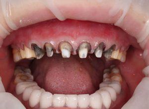 Mài răng bọc sứ - Đẹp nhanh chóng, khổ cả đời....Liệu có đáng?