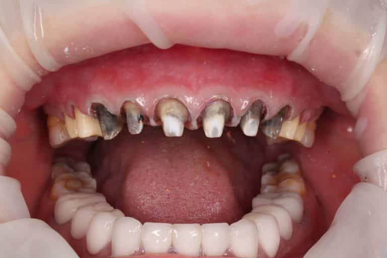 Răng của một khách hàng đã từng bọc sứ và được tháo ra để điều trị lại do viêm lợi