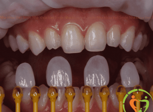 Miếng dán veneer mỏng thế nào?