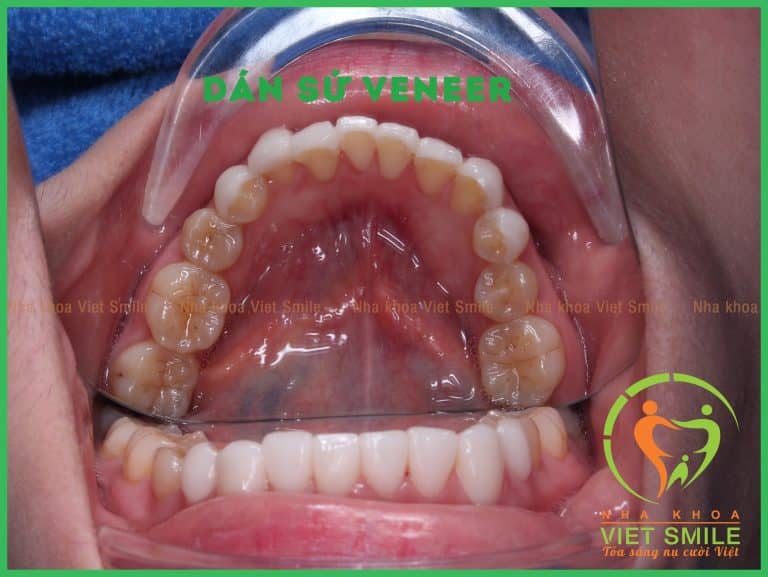 Sự khác biệt giữa dán sứ veneer và bọc răng sứ chính là khả năng bảo tồn men răng