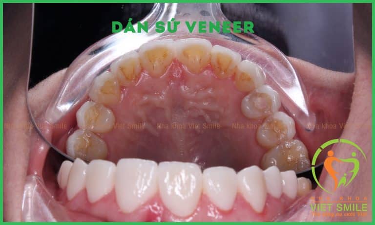 Dán sứ veneer - bảo tồn 100% mặt trong của răng