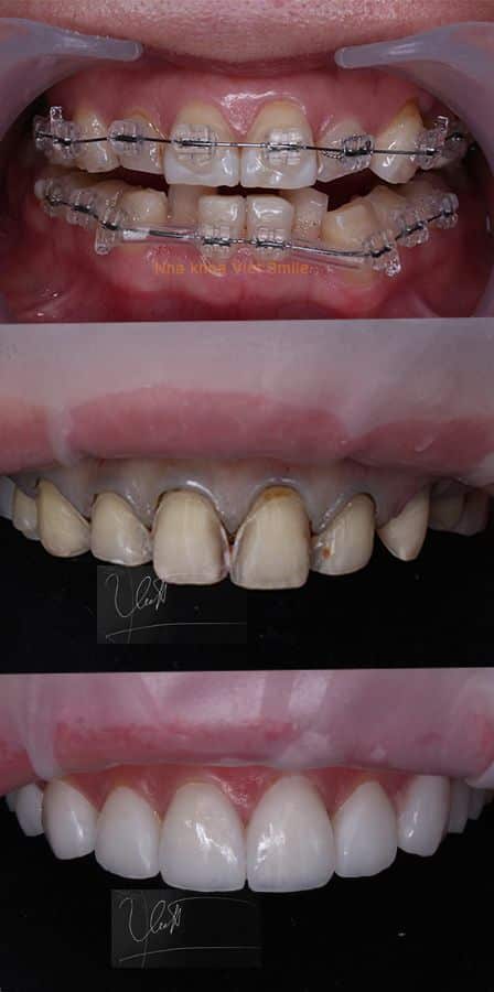 Thay đổi nụ cười sau khi niềng răng và dán sứ veneer 3 Dan su veneer nha khoa viet smile