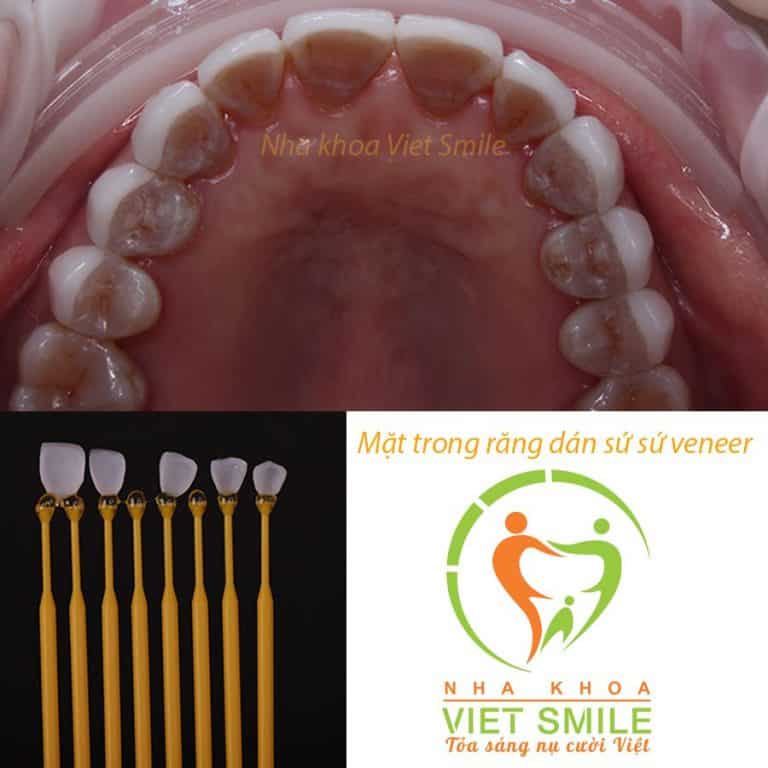 Khách hàng nguyễn thị hải yến 20 răng dán sứ veneer 4 Mặt trong của răng dán sứ veneer