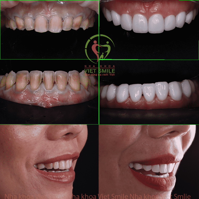 Răng trắng đẹp nhưng cần chắc khỏe - dán sứ veneer chính là giải pháp dành cho bạn