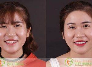 Dán sứ veneer có ăn nhai bình thường không?