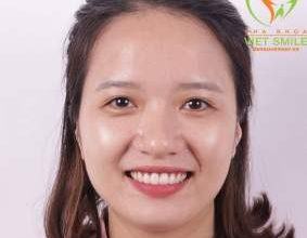 Cắt lợi thẩm mỹ - Thay đổi cuộc đời