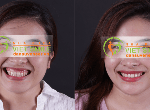 Chi phí cắt lợi thẩm mỹ tại Nha khoa Việt Smile