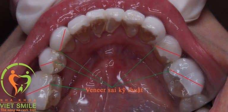 Dán veneer sai kỹ thuật để lại những hậu quả nghiêm trọng cho cả hàm răng
