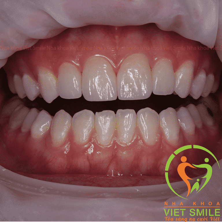Màu sắc 4 răng sứ veneer sau khi dán so với các răng khác trên cung hàm