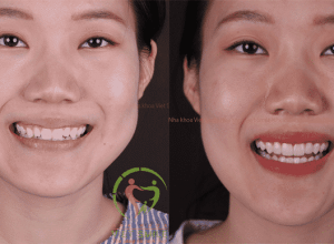 Dán sứ veneer có bền không?